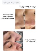 چسب بینی ورقه ای لانبنا