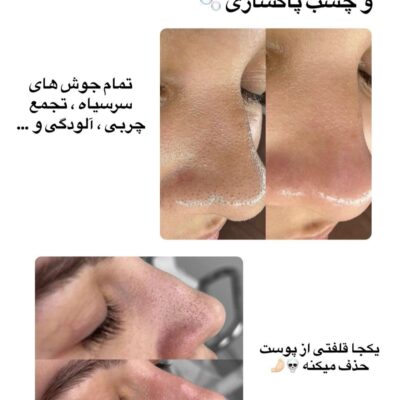 چسب بینی ورقه ای لانبنا