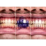 ژل سفید کننده دندان فوری V34 glory smile - Image 3